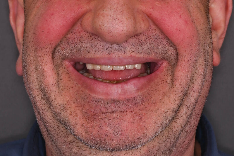 Zâmbet lateral stanga_înainte